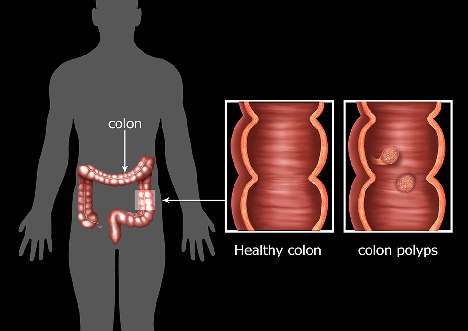 Colonic Polyps Oxford Gut And Liver   Colonic Polyps 